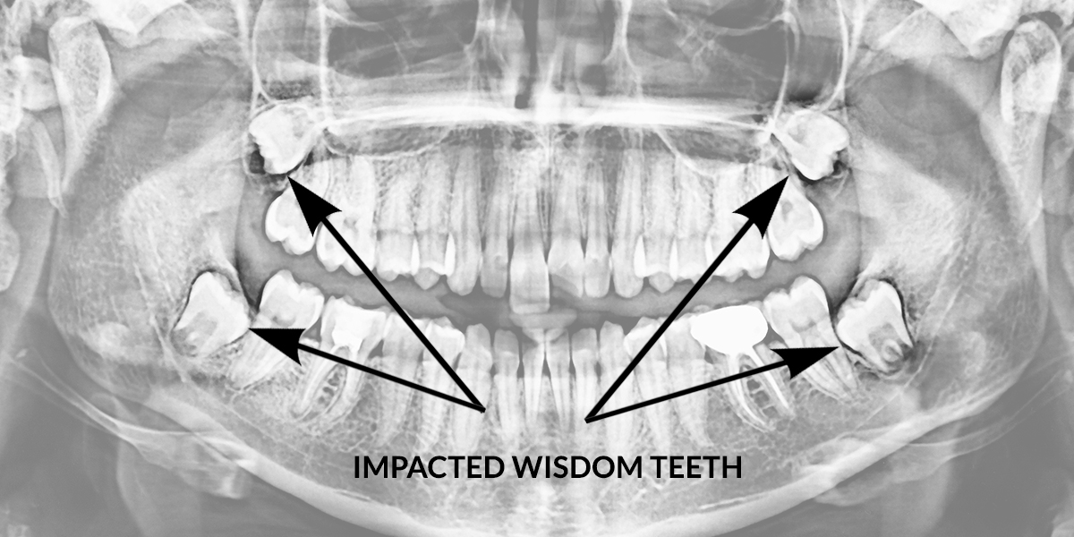 impacted wisdom tooth xray